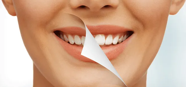 سفید کردن دندان به روش بلیچینگ
