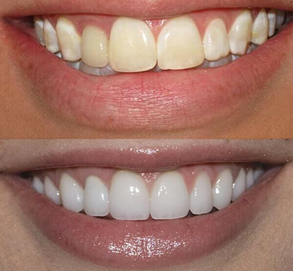 عکس قبل و بعد روکش دندان
