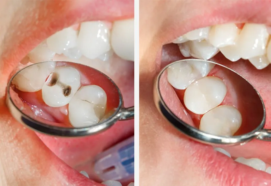روش ترمیم دندان