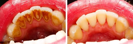 عکس قبل و بعد جرم گیری دندان