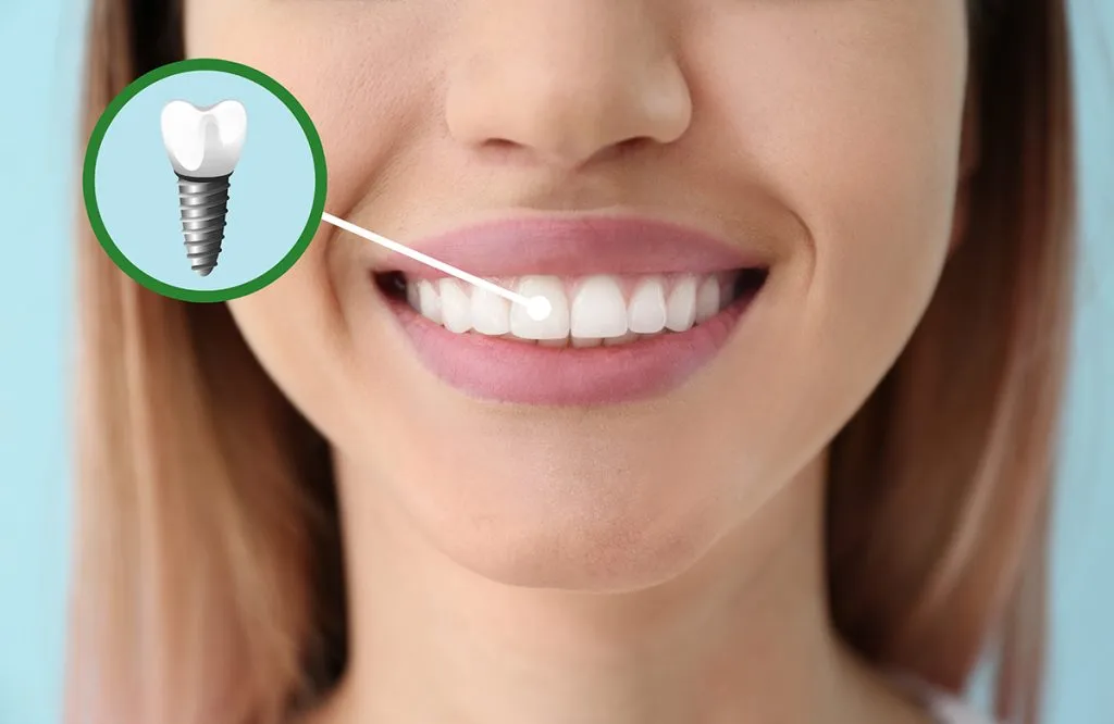 ایمپلنت دندان چگونه انجام می شود