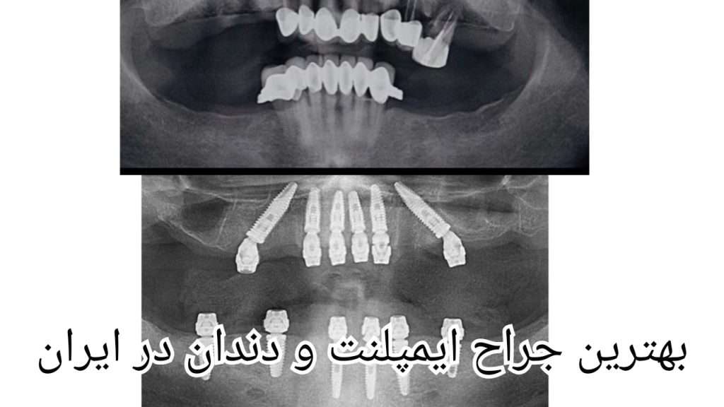 بهترین جراح ایمپلنت و دندان در ایران