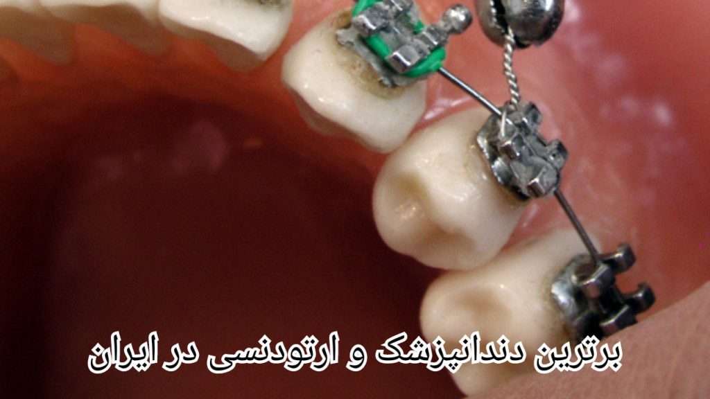 معایب ارتودنسی توسط برترین دندانپزشک و ارتودنسی در ایران