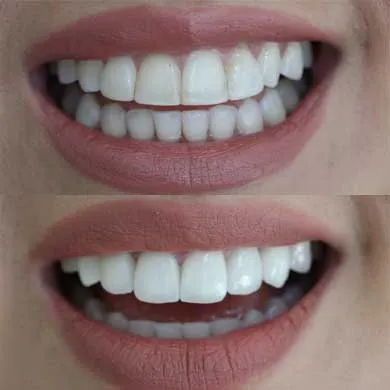 عکس قبل و بعد کامپوزیت دندان