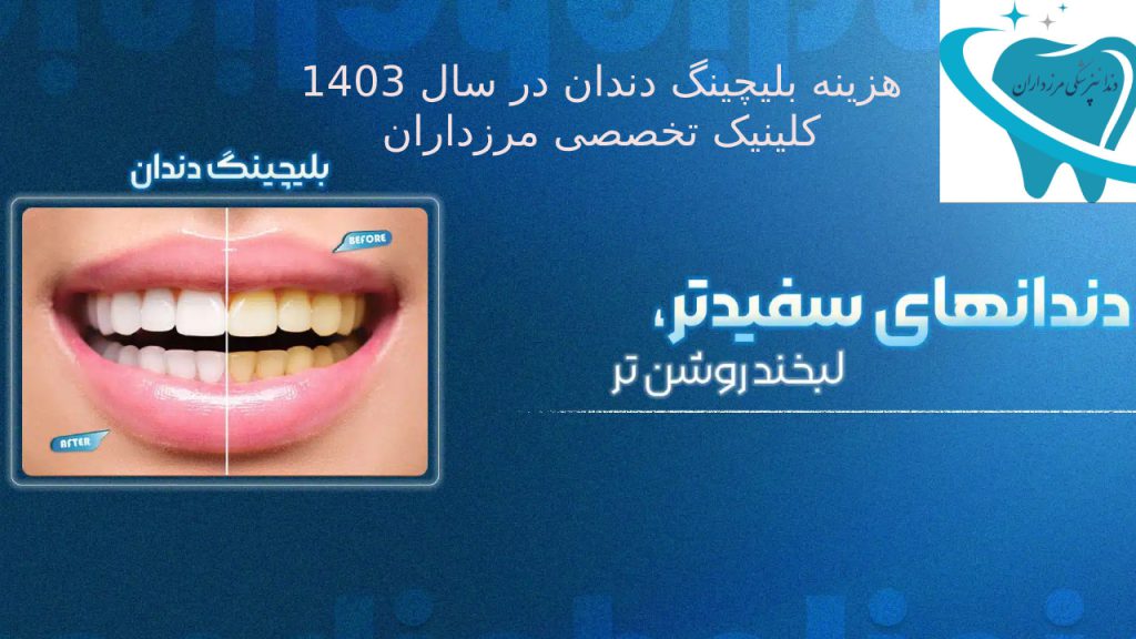 هزینه بلیچینگ دندان در سال 1403 کلینیک مرزداران