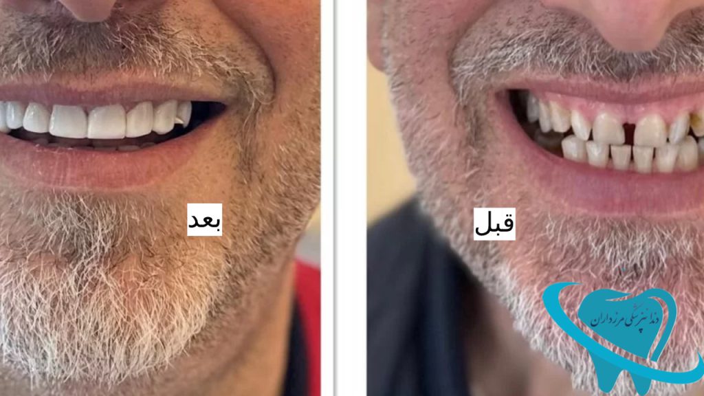 عکس کامپوزیت دندان قبل و بعد مرزداران