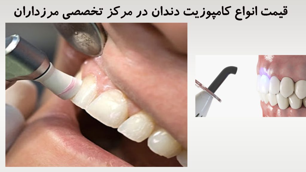 قیمت انواع کامپوزیت دو تصویر بزرگ و کوچک از دندان های یک شخص در حا لانجام کامپوززیت دندان