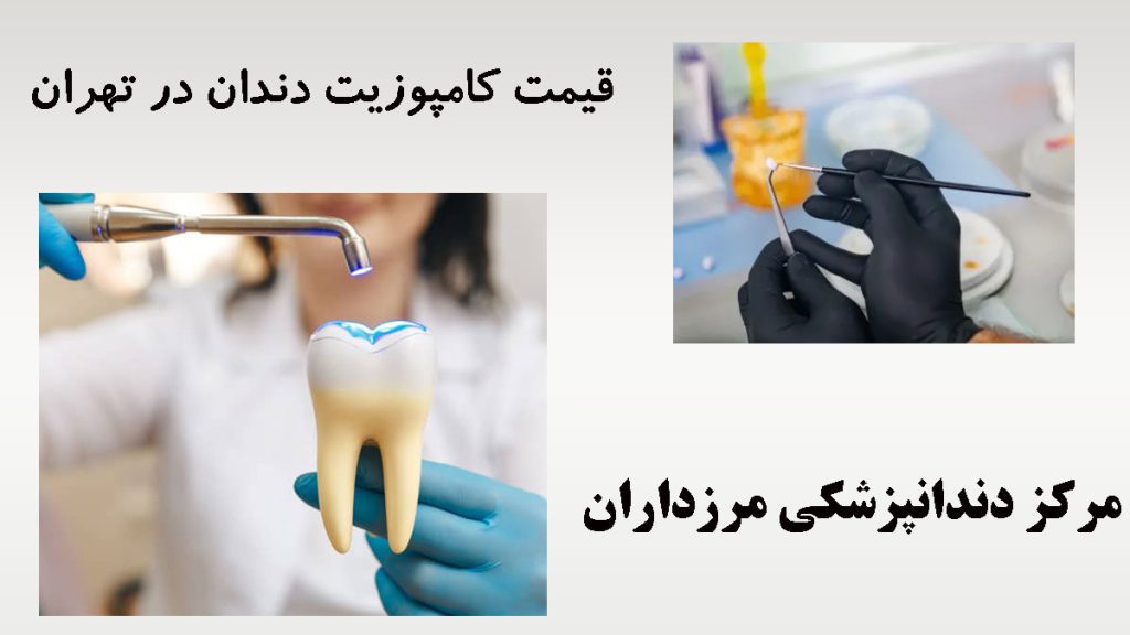 قیمت کامپوزیت دندان دو تصویر از کامپوزیت و یک مولاژدندان در دست پزشک-نوشته :قیمت کامپوزیت دندان در تهران