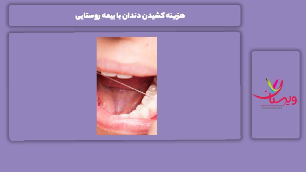 ویژگی بیمه روستایی برای دندانپزشکی هزینه کشیدن دندان با بیمه روستایی