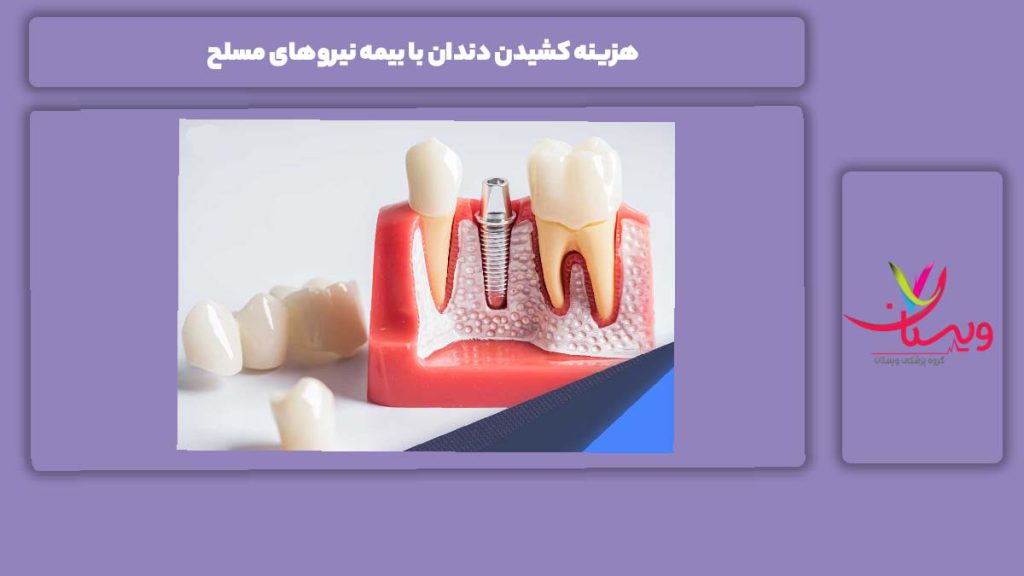 ترعفه دندانپزشکی با بیمه نیروی مسلح هزینه کشیدن دندان با بیمه نیروهای مسلح