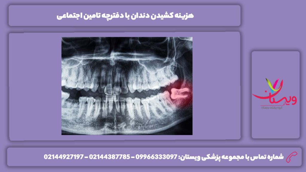 قیمت کشیدن دندان با بیمه تامین اجتماعی هزینه کشیدن دندان با دفترچه تامین اجتماعی