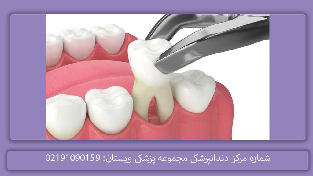 هزینه کشیدن دندان در درمانگاه دولتی