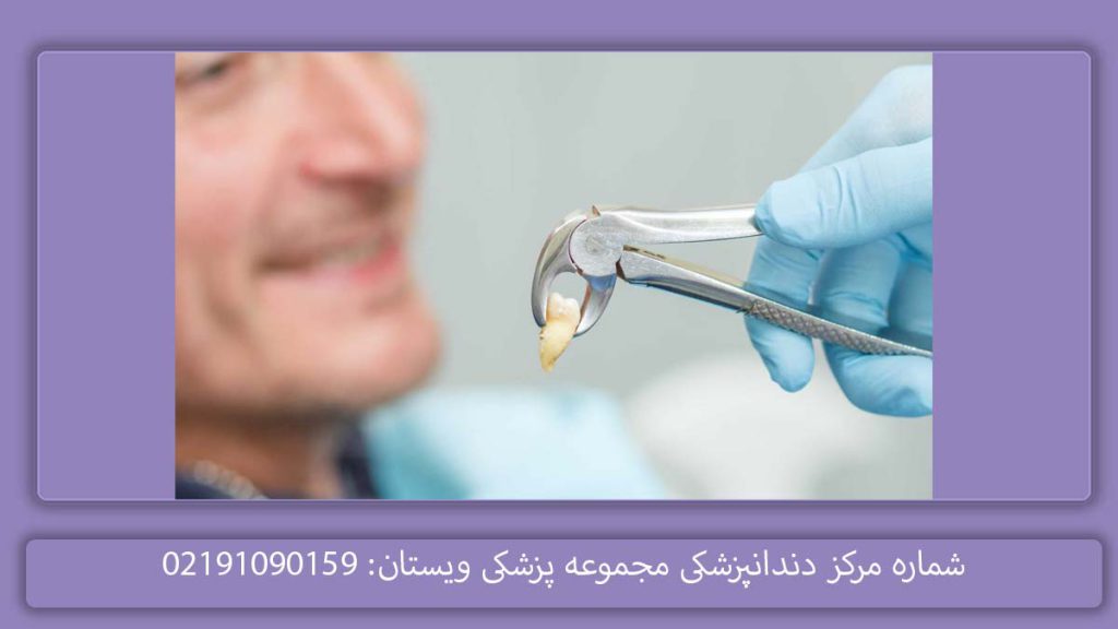 تعرفه کشیدن دندان عقل هزینه کشیدن دندان عقل در درمانگاه دولتی