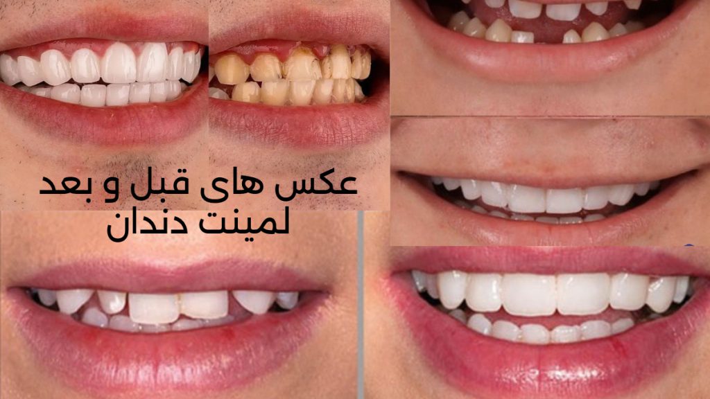 قبل و بعد لمینت تصاویری از قبل و بعد لمینت دندان