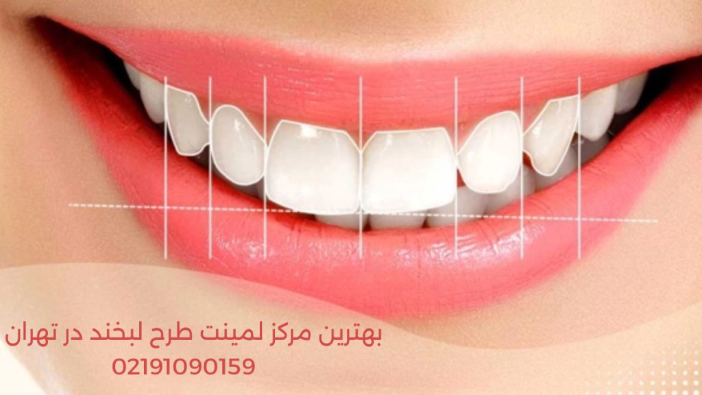 لمینت دندان طرح لبخند بهترین مرکز لمینت دندان طرح لبخند