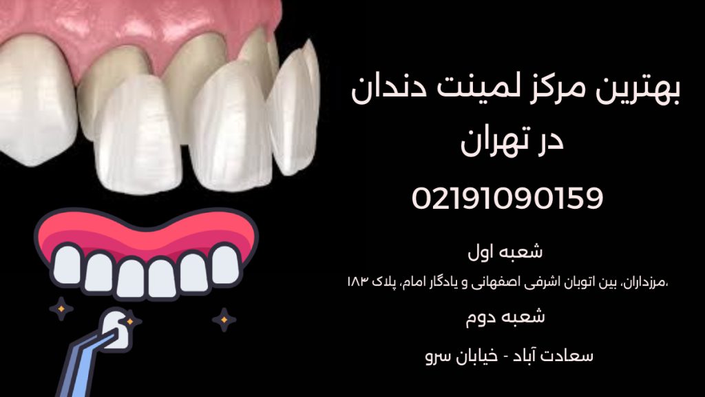 آیکون لامینت دندان و معرفی بهترین مرکز لمینت دندان در تهران