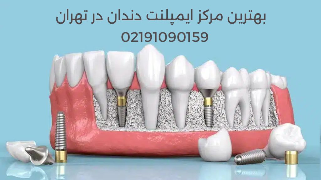 لیست بهترین مرکز ایمپلنت دندان در تهران به همراه آدرس و شماره تلفن