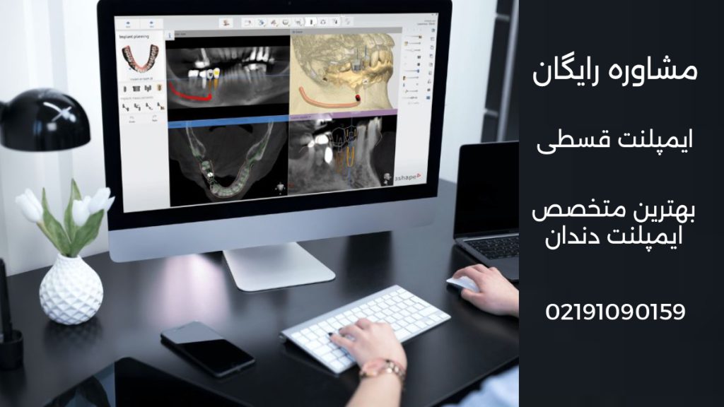 پیوند فک برای دندان تصویری از یک متخصص حرفه ای در حال تحلیل وضعیت فک دندان برای ایمپلنت دندان