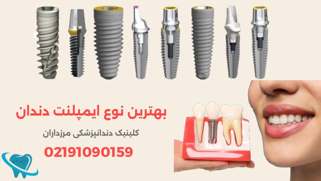 بهترین نوع ایمپلنت دندان چیست؟ تصاویری از برندهای ایمپلنت دندان