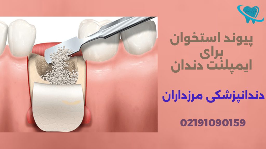 پیوند قبل از کاشت دندان تصویری از پیوند استخوان برای انجام ایمپلنت دندان در کسانی که لثه ضعیفی برای کاشت دندان دارند