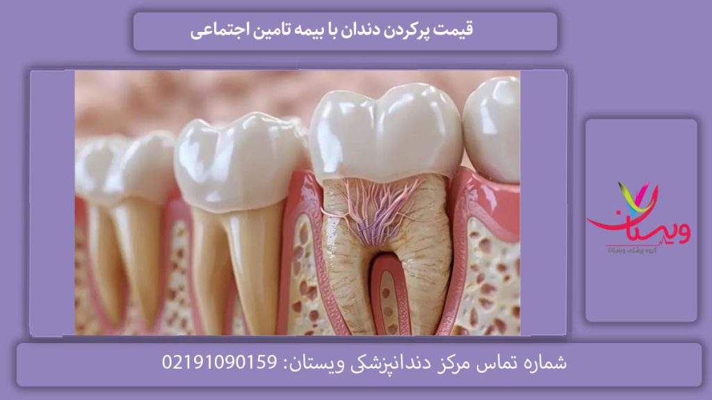 هزینه پرکردن دندان با بیمه تامین اجتماعی