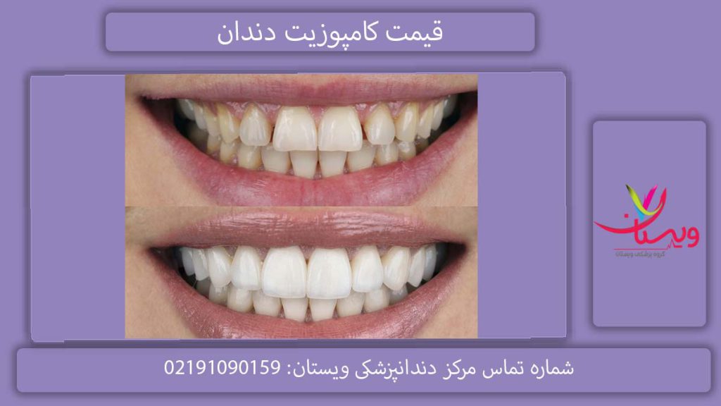 هزینه کامپوزیت دندان چقدر است؟