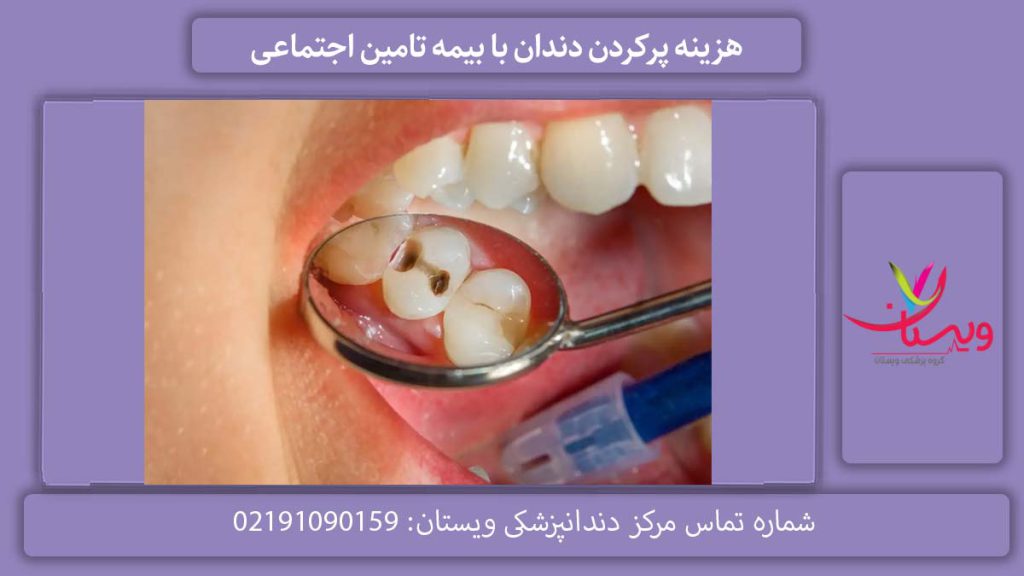 تعرفه پر کردن دندان 1405 هزینه پرکردن دندان با بیمه تامین اجتماعی
