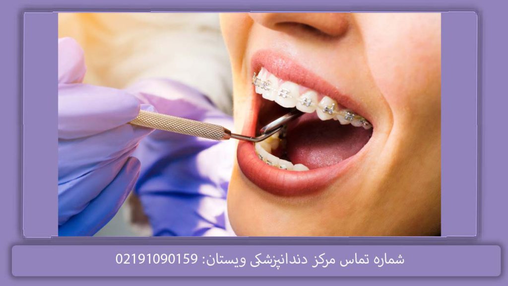 پر کردن دندان با بیمه تکمیلی هزینه پرکردن دندان با بیمه تامین اجتماعی و تکمیلی