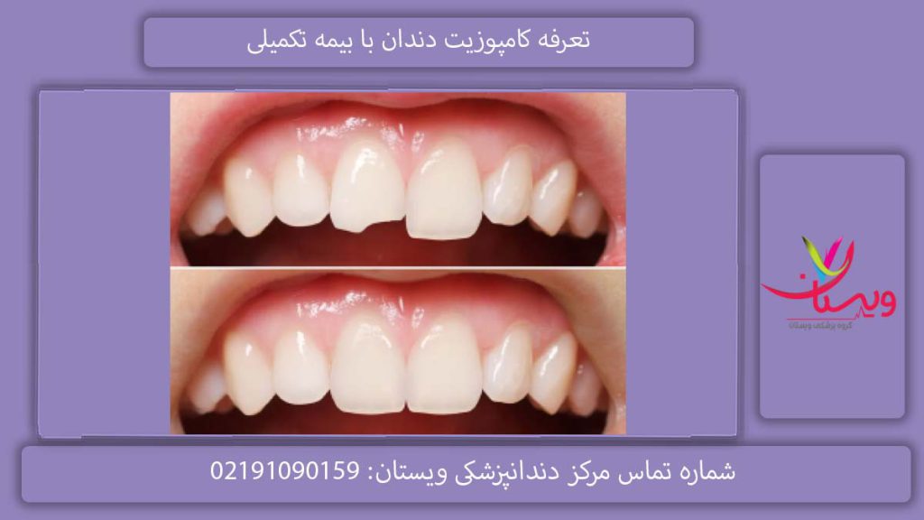 هزینه کامپوزیت دندان با بیمه تکمیلی جقدر است؟