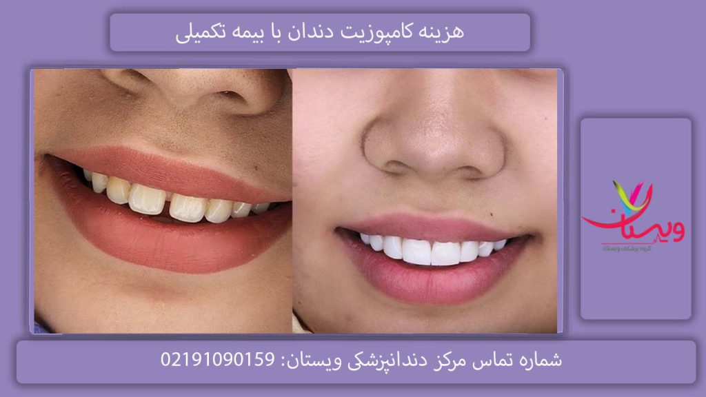 نرخ ترمیم با بیمه تکمیلی هزینه کامپوزیت دندان با بیمه تکمیلی