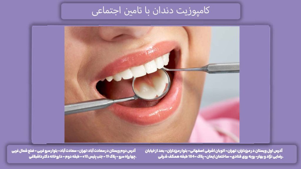 کامپوزیت دندان با تامین اجتماعی هزینه کامپوزیت دندان با بیمه تامین اجتماعی