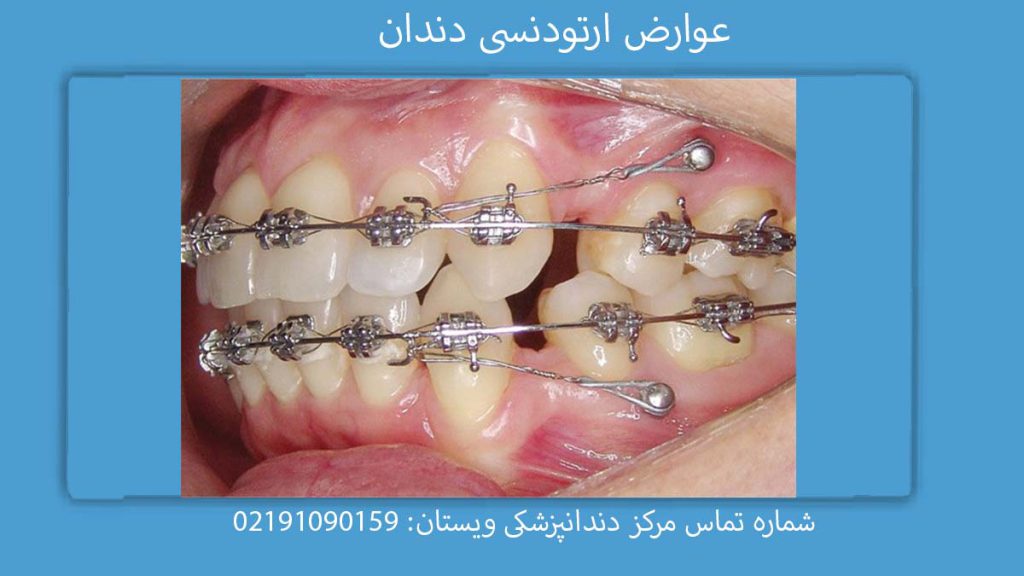 عوارض ارتودنسی دندان عوارض ارتودنسی در بارداری