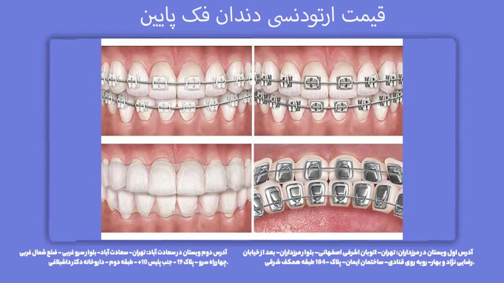 نرخ سیمکشی دندان فک پایین قیمت ارتودنسی دندان فک پایین