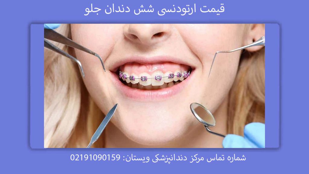 تعرفه ارتودنسی شش دندان جلویی قیمت ارتودنسی دندان جلو (6تایی)