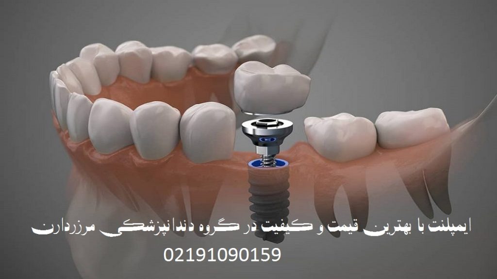 ایمپلنت دندان در گروه دندانپزشکی مرزدارن تصویری از نحوه ایمپلنت دندان و جنس آن و پیچ ایمپلنت در دندان