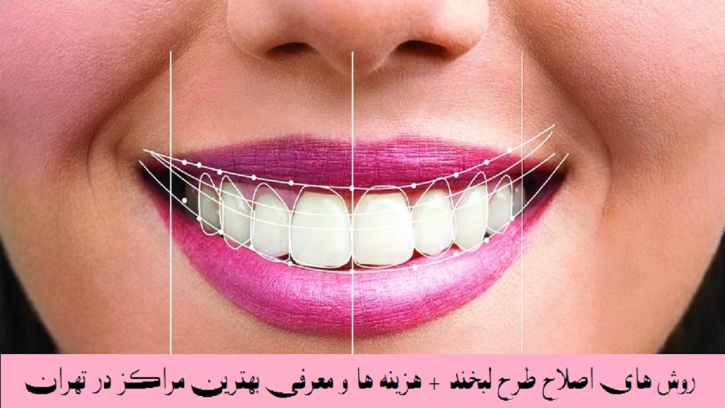 روش های اصلاح طرح لبخند تصویری از یک لبخند زیبا با دندان های سالم و سفید